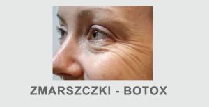 Zmarszczki wokół oczu botox